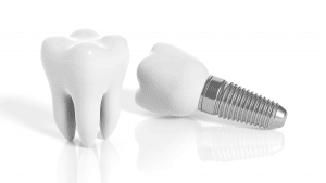 Highland Park Dental Implants implant 300x169