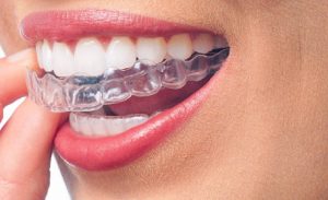 Invisalign braces alternative