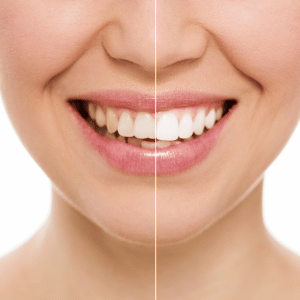 Wilmette Teeth Cleaning & Whitening twhitening 300x300